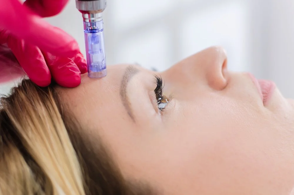 Skincare specialist performing precise microneedling with focused technique and sterile professional tools
